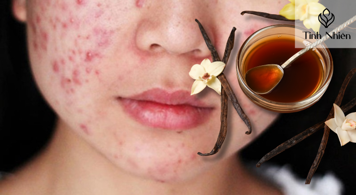 Điều trị mụn trứng cá 